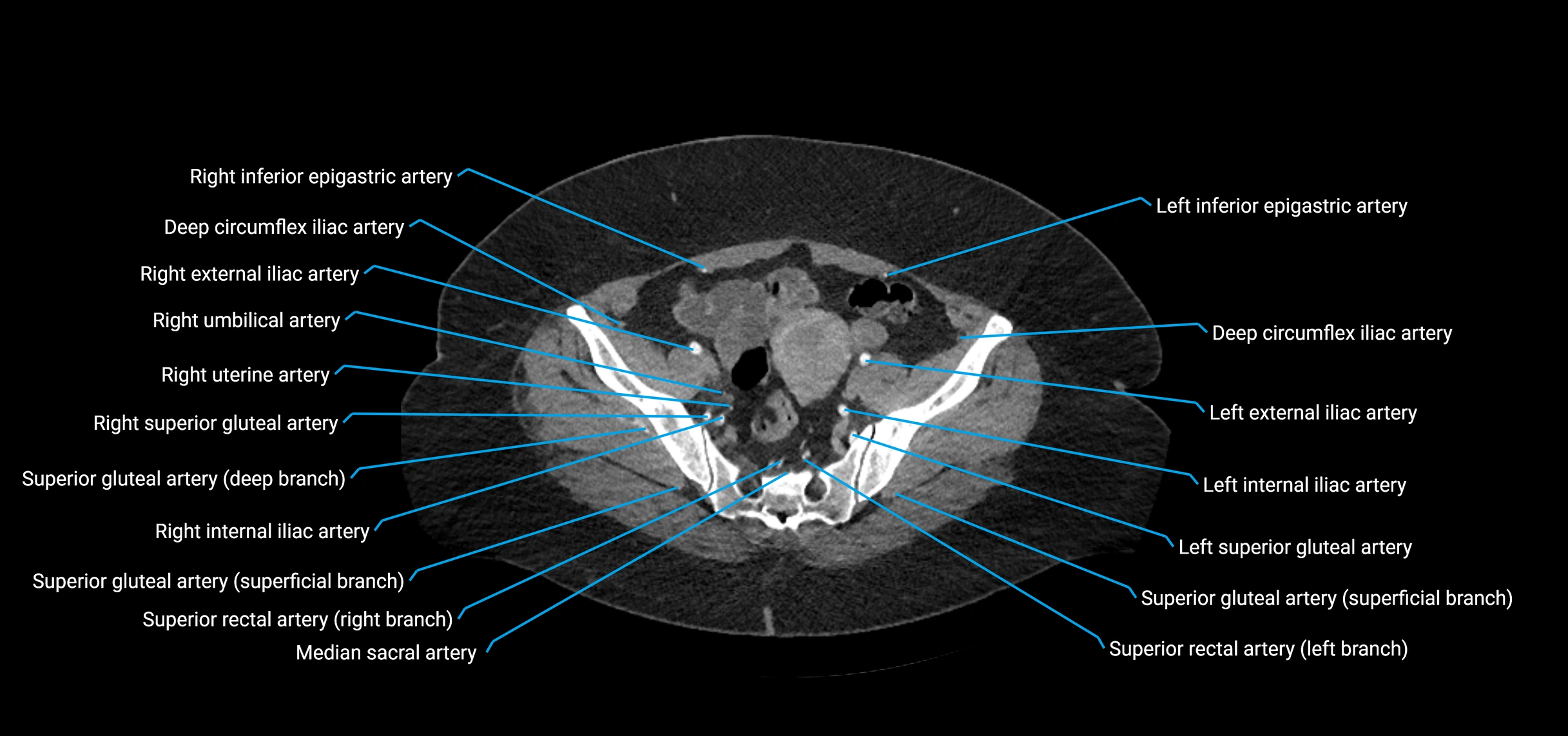 CTA abdomen axial cross sectional anatomy labelled image_205 (2).webp